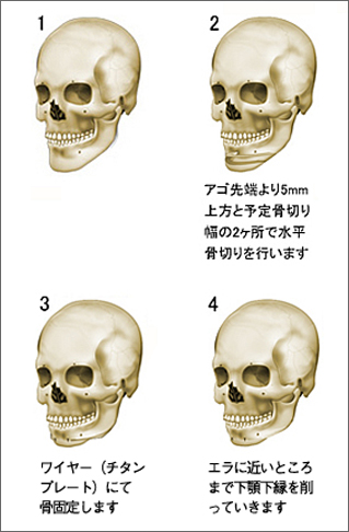 顎 あご 短縮 水平骨切りなど 輪郭 美容整形のリッツ美容外科