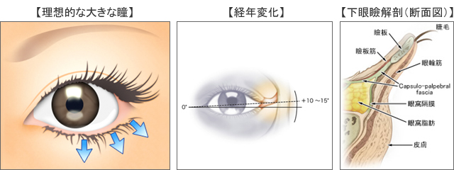 下眼瞼拡大 垂れ目形成 目 眼瞼 美容整形のリッツ美容外科