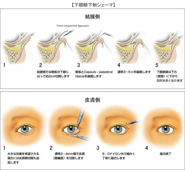 下眼瞼拡大 垂れ目形成 目 眼瞼 美容整形のリッツ美容外科