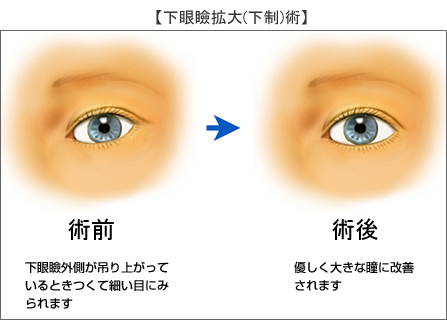 下眼瞼拡大 垂れ目形成 目 眼瞼 美容整形のリッツ美容外科