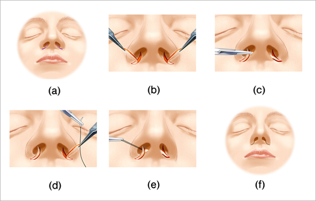 小鼻縮小 鼻翼縮小 挙上術 鼻 美容整形のリッツ美容外科