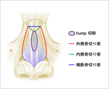 鼻骨骨切り 斜鼻 鼻中隔弯曲 鼻 美容整形のリッツ美容外科