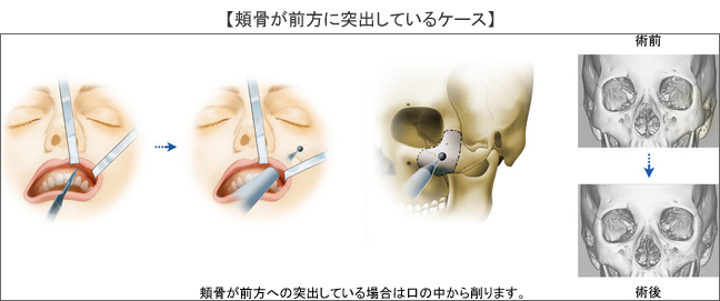 頬骨が前方に突出しているケース