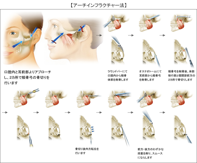 アーチインフラクチャー法