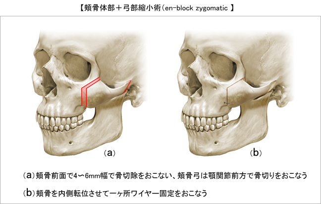 頬骨骨切り 輪郭 美容整形のリッツ美容外科