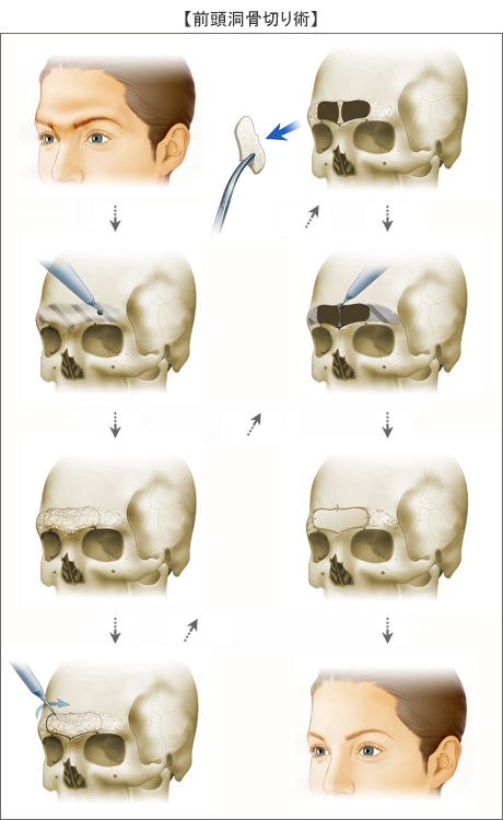 額 後退 前頭洞骨切り 輪郭 美容整形のリッツ美容外科