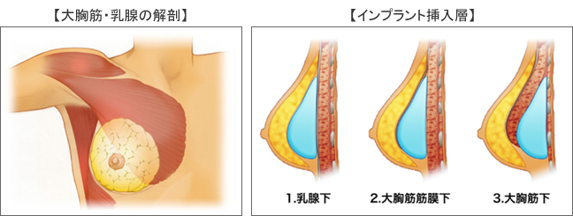 シリコンバッグ-バスト｜美容整形のリッツ美容外科