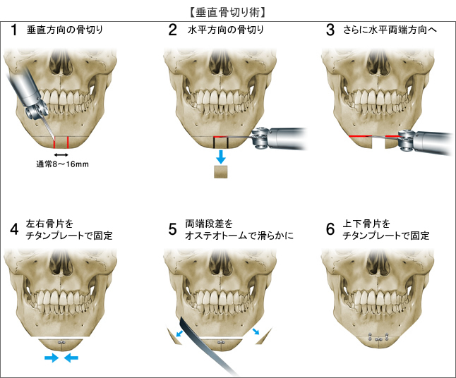 両顎の手術費用