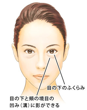 経結膜ハムラ法 裏ハムラ法 目 眼瞼 しわ たるみ改善 美容整形のリッツ美容外科