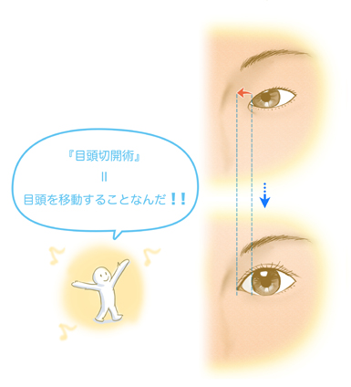 目頭切開=目頭を移動すること