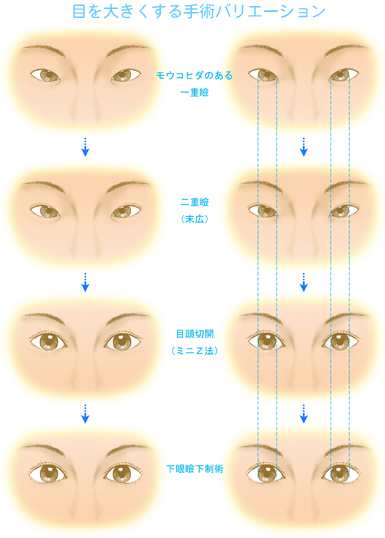 目を大きくする手術バリエーション