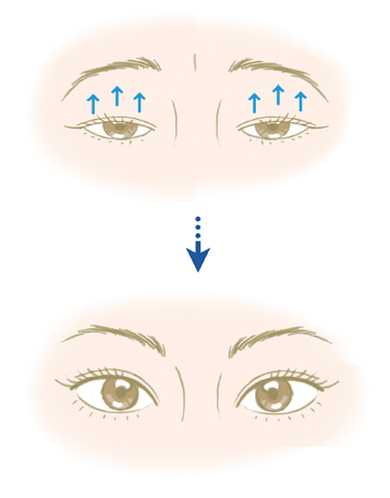 まぶたを引き上げます