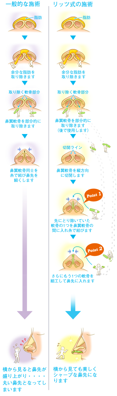 リッツの術式はこう違う！