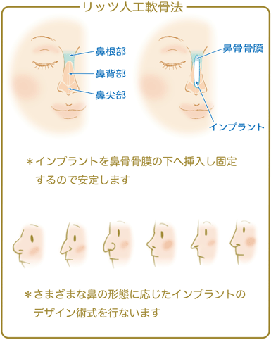 リッツ人工軟骨法