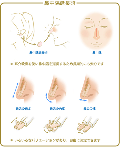 鼻中隔延長術