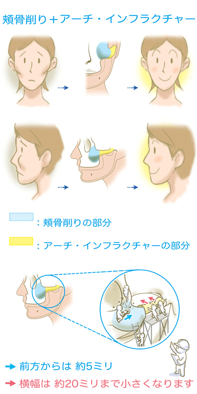 アーチ・インフラクチャー