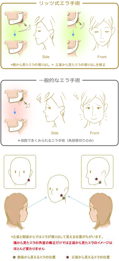 リッツ式エラ手術