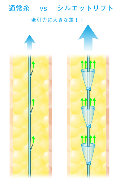通常糸vsシルエットリフト