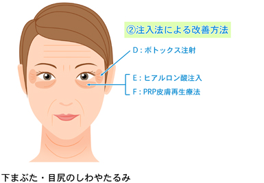 (2) 注入法による改善方法