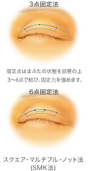 スクエア・マルチプル・ノット法の埋没法施術