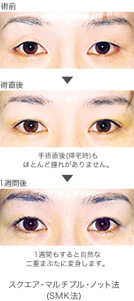 二重の症例写真