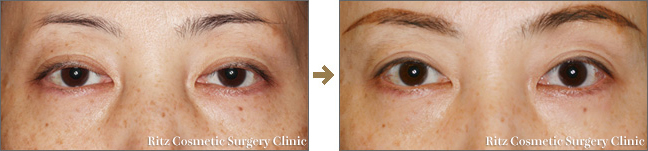 眼瞼下垂 目 眼瞼 しわ たるみ改善 美容整形のリッツ美容外科