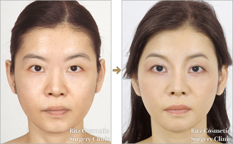 ゴアテックス 鼻根部vライン形成 鼻 美容整形のリッツ美容外科 ゴアテックス 鼻根部vライン形成 鼻 美容整形のリッツ美容外科