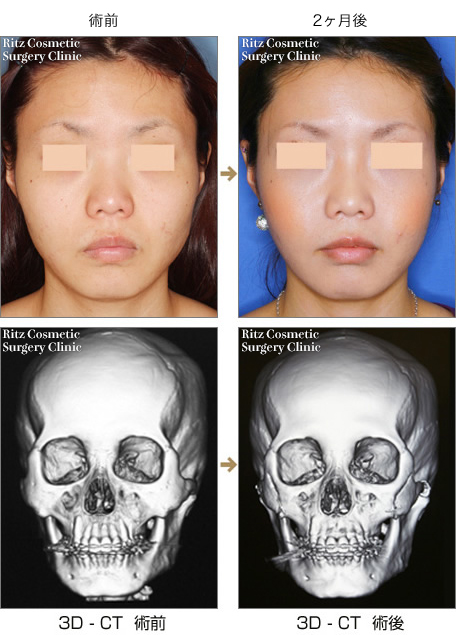 頬骨縮小術