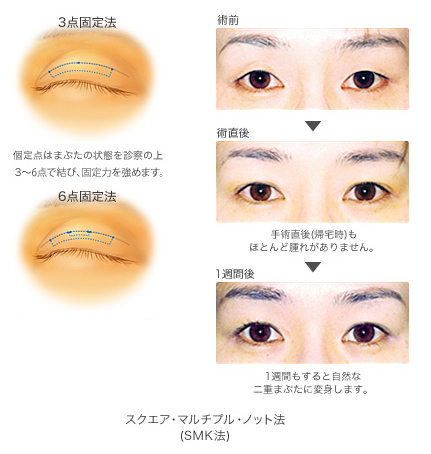 二重整形 2点留め