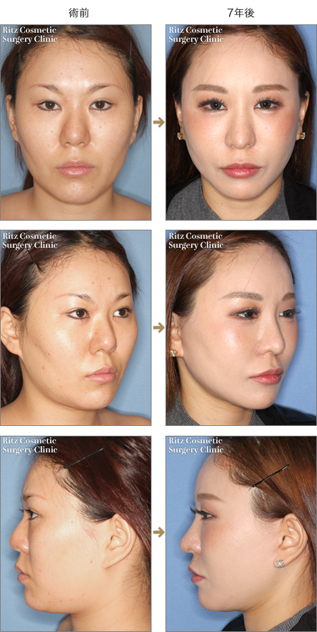 鼻中隔延長術 鼻 美容整形のリッツ美容外科 鼻中隔延長術 鼻 美容整形のリッツ美容外科