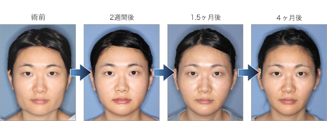エラ骨切り 輪郭 美容整形のリッツ美容外科 エラ骨切り 輪郭 美容整形のリッツ美容外科