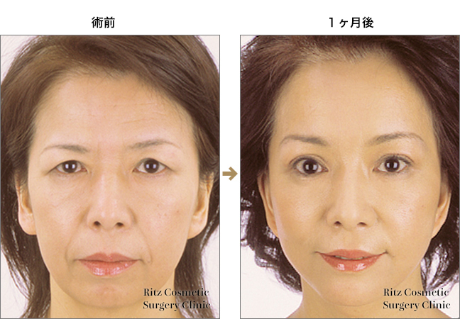 内視鏡上眼瞼リフト 目 眼瞼 美容整形のリッツ美容外科