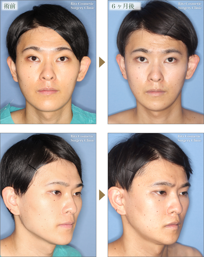 頬骨骨切り 輪郭 美容整形のリッツ美容外科