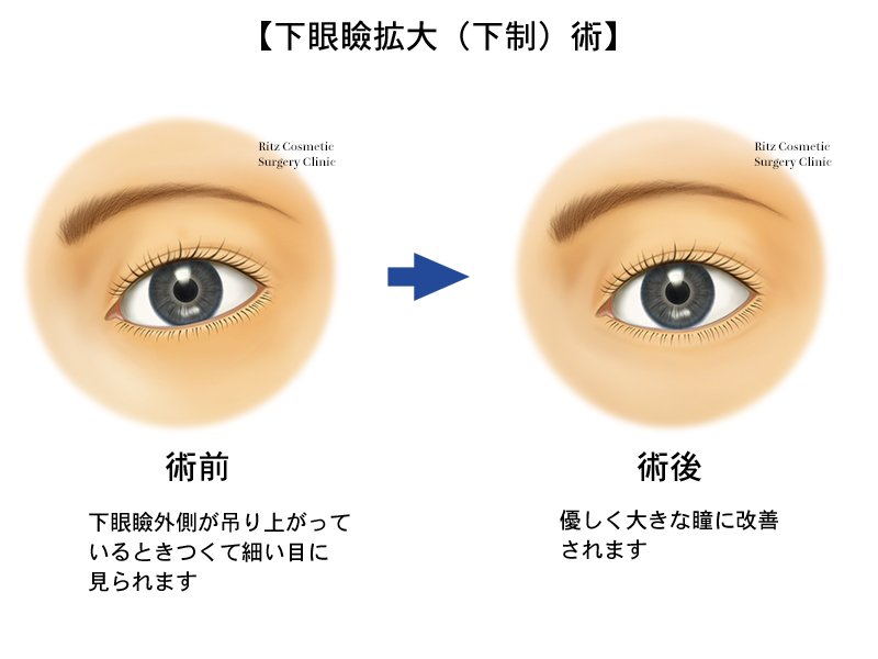 下眼瞼拡大 垂れ目形成 目 眼瞼 美容整形のリッツ美容外科