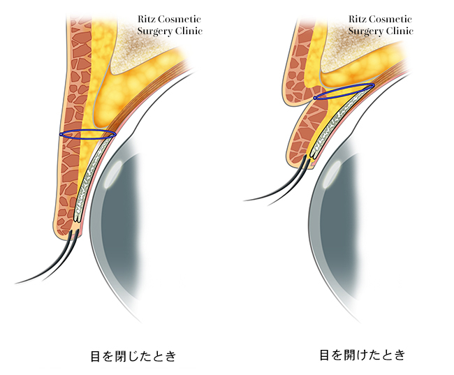 3点固定埋没法の詳細