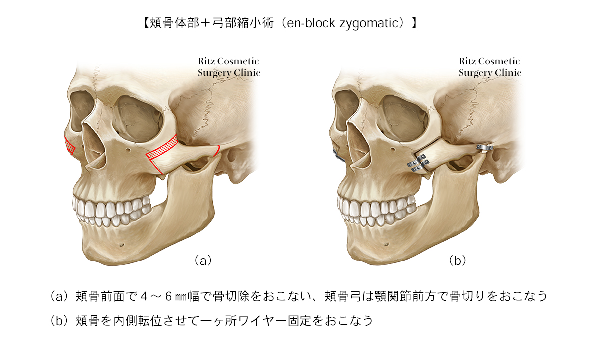頬骨 整形の手法
