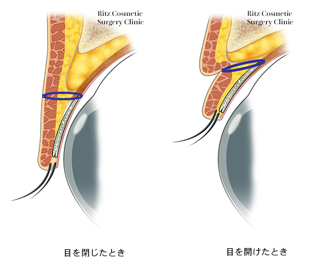 6点固定埋没法断面図